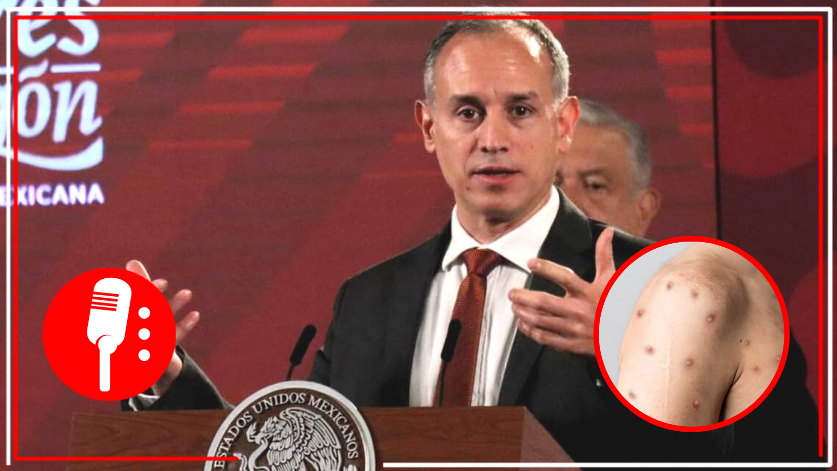 Confirma Hugo López-Gatell cinco casos de viruela del mono en México