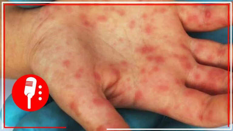 La OMS declara la alerta máxima por viruela símica tras aumento de casos en el mundo