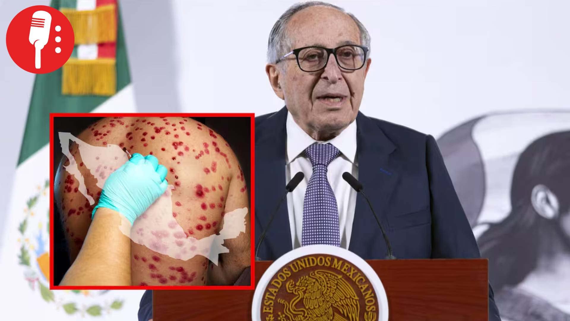 Casos activos de sarampión muestran tendencia a la baja en México