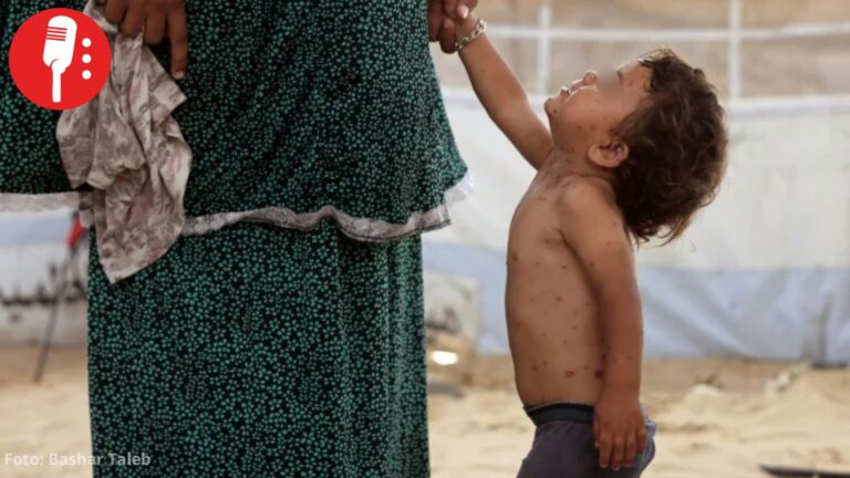 Varicela se propaga en campamentos de Gaza por hacinamiento y falta de agua potable